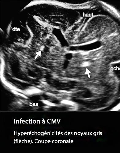 CMV 5