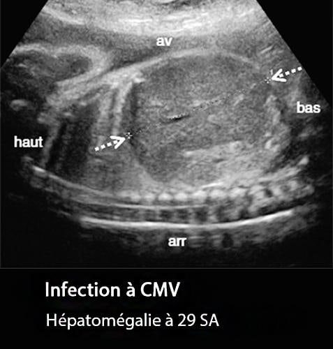 CMV 6