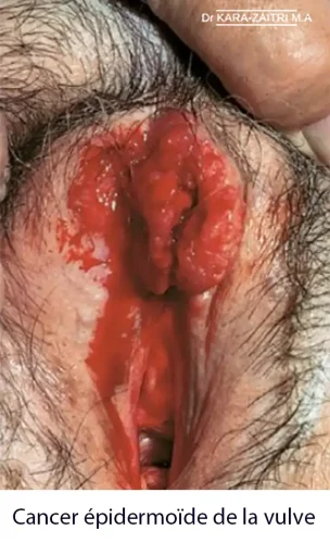 Cancer de la vulve épidermoide