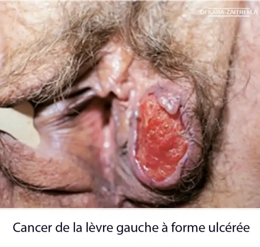 Cancer de la vulve — aspect clinique