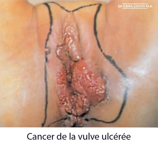 Cancer de la vulve ulcéré