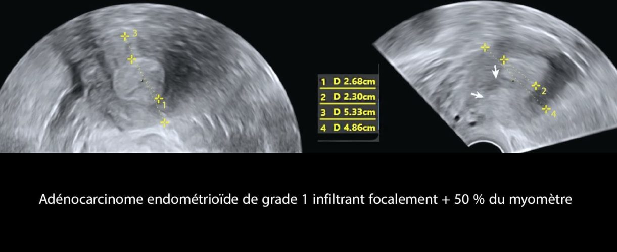 Cancer de l'endomètre_1