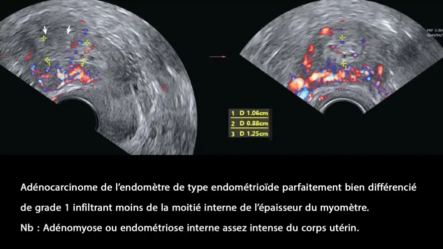 Cancer de l'endomètre_3
