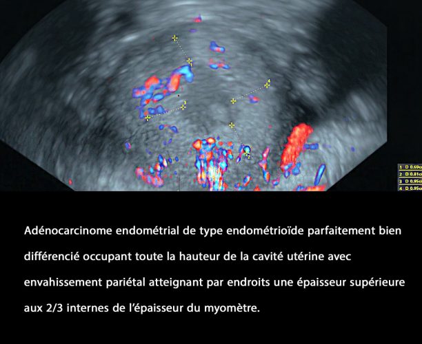 Cancer de l'endomètre_4