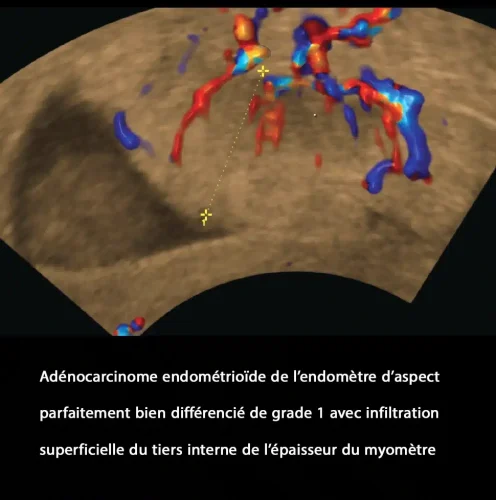 Cancer de l'endomètre_5