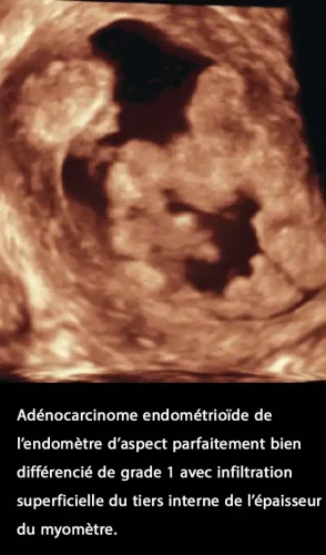 Cancer de l'endomètre_6