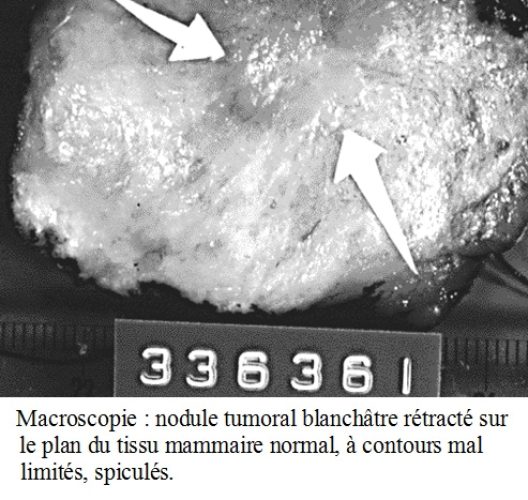 Cancer du sein macroscopie — aspect anatomopathologique tumeur mammaire