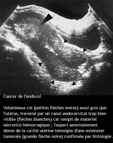Cancer endocol_echo