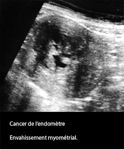 Cancer de l'endomètre — carcinome endométrial image échographique 1