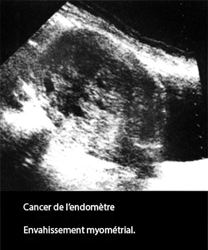Cancer de l'endomètre — carcinome endométrial image échographique 2