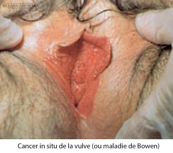 Cancer in situ de la vulve — carcinome épidermoïde vulvaire