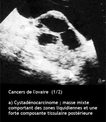 Cancer de l'ovaire — aspect macroscopique chirurgical 1
