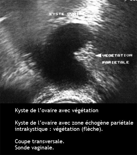 Cancer de l'ovaire — aspect macroscopique chirurgical 10