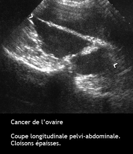 Cancer de l'ovaire — aspect macroscopique chirurgical 11