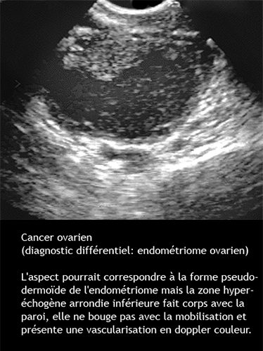 Cancer de l'ovaire — aspect macroscopique chirurgical 12