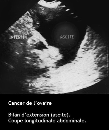 Cancer de l'ovaire — aspect macroscopique chirurgical 13