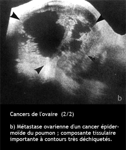 Cancer de l'ovaire — aspect macroscopique chirurgical 2