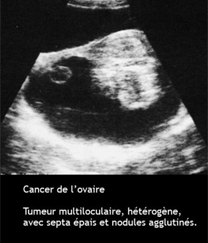Cancer de l'ovaire — aspect macroscopique chirurgical 3