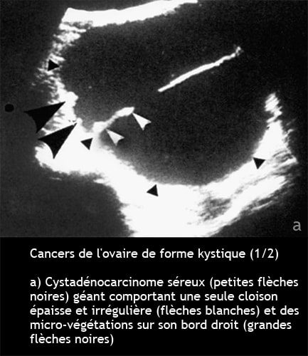 Cancer de l'ovaire — aspect macroscopique chirurgical 4