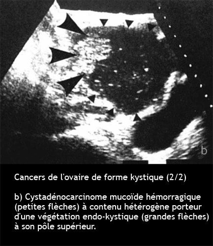 Cancer de l'ovaire — aspect macroscopique chirurgical 5