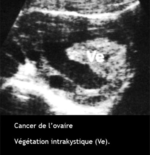 Cancer de l'ovaire — aspect macroscopique chirurgical 6