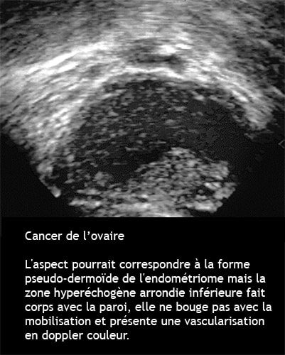 Cancer de l'ovaire — aspect macroscopique chirurgical 7