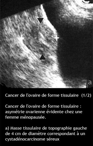 Cancer de l'ovaire — aspect macroscopique chirurgical 8