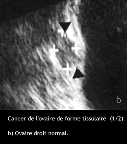 Cancer de l'ovaire — aspect macroscopique chirurgical 9
