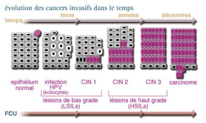 Cancer du col CIN — néoplasie intraépithéliale cervicale progression