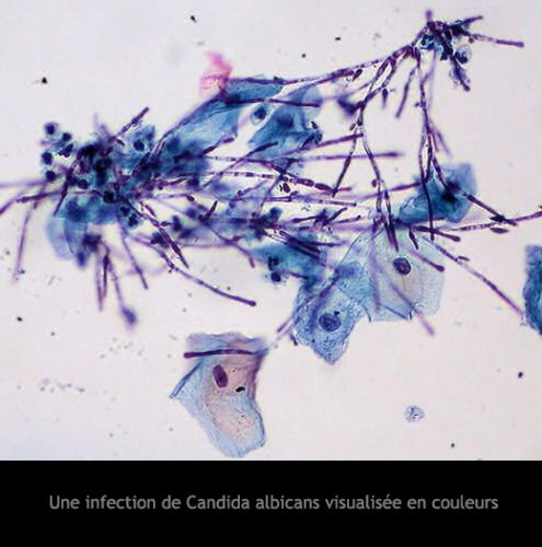 Candida albicans_infection
