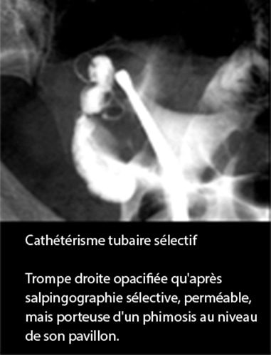 Cathétérisme tubaire — technique reperméabilisation tubaire 1