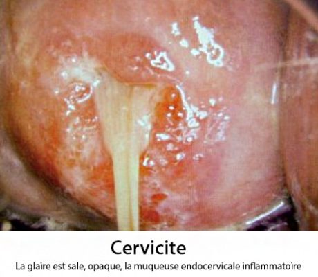 prelev prélèvement bactériologique cervicites