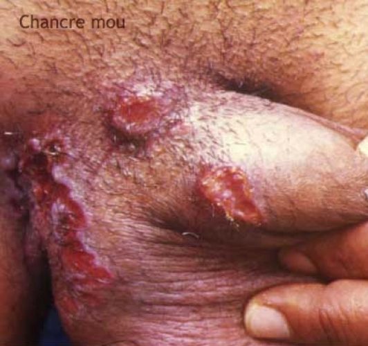 Chancre mou 1