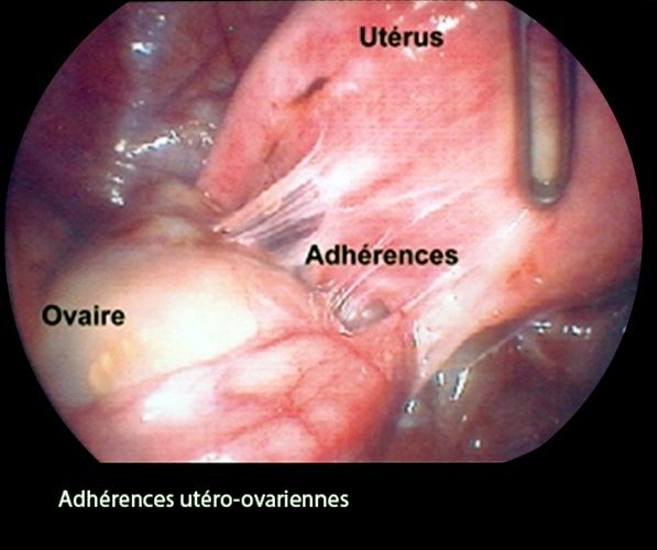 Coelio_adhérences