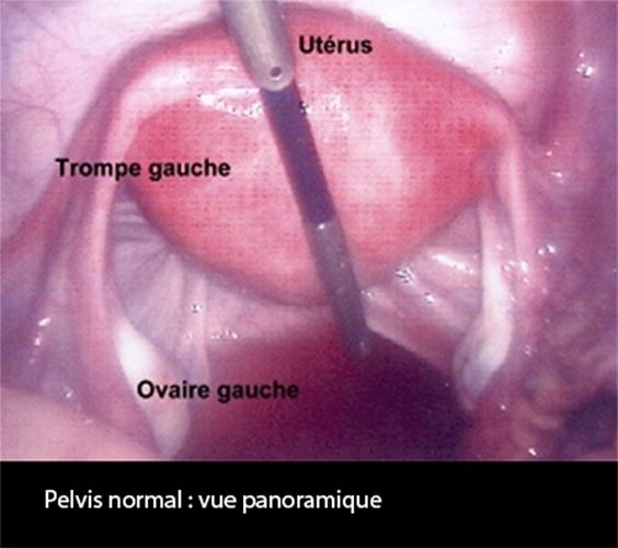 Coelio_pelvis normal 2