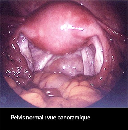 Coelio_pelvis normal