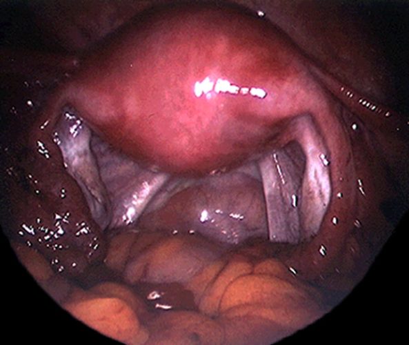 Coelio_pelvis normal