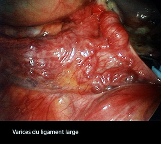 Coelio_varices ligt large