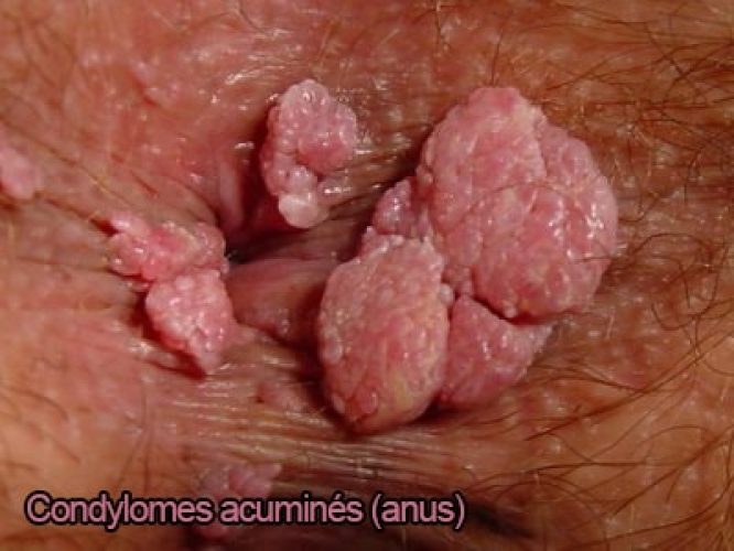 Condylome exophytique (crête de coq) — lésion HPV génitale