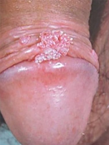 Condylome exophytique (crête de coq) — lésion HPV génitale