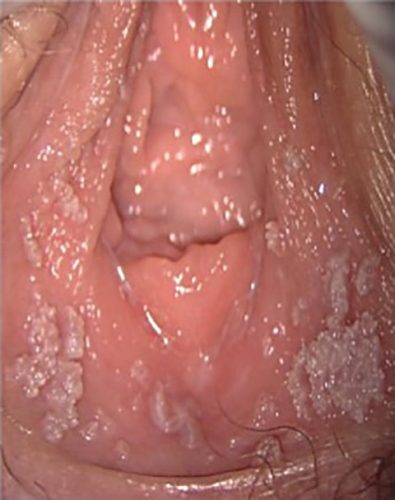 Condylomes exophytiques (crête de coq) — lésion HPV génitale