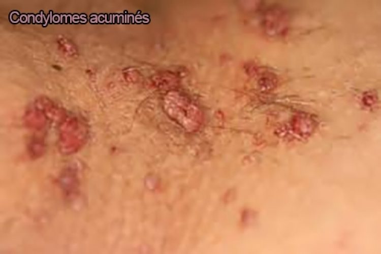 Condylomes exophytiques (crête de coq) — lésion HPV génitale