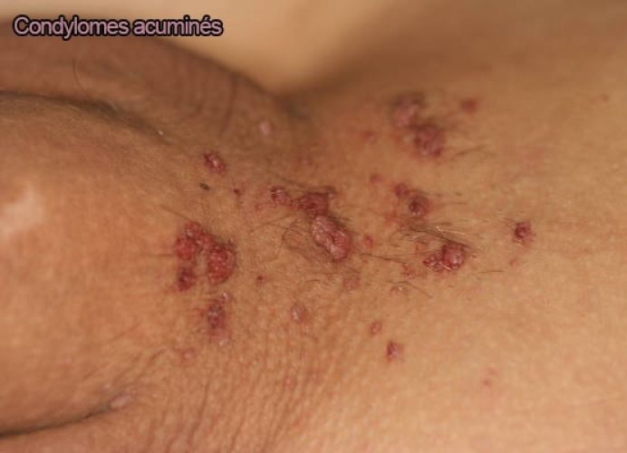 Condylome exophytique (crête de coq) — lésion HPV génitale