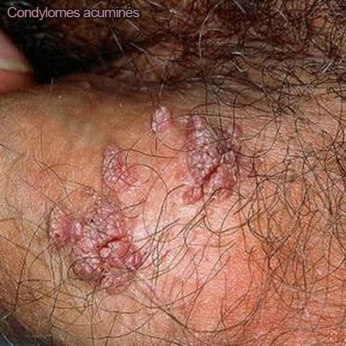 Condylome exophytique (crête de coq) — lésion HPV génitale