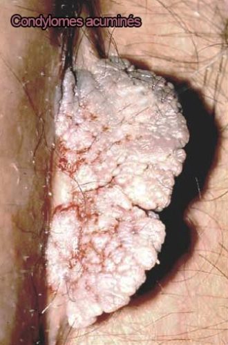 Condylome exophytique (crête de coq) — lésion HPV génitale