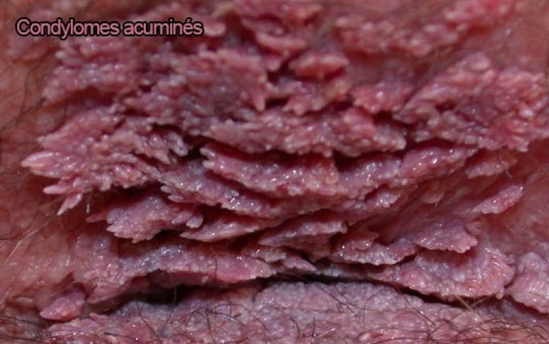 Condylome exophytique (crête de coq) — lésion HPV génitale