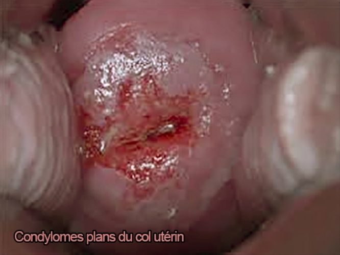 Condylomes acuminés — végétations vénériennes HPV 9