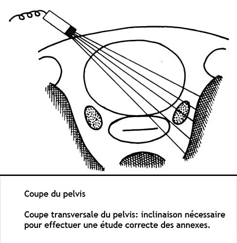 Coupe pelvis 3