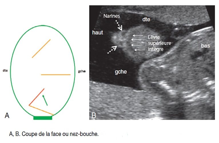 Coupe nez bouche fœtale — échographie morphologie faciale profil
