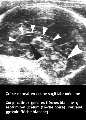 Crane normal 1